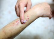 6 Gejala Diabetes pada Kulit, Bercak Gelap Tanda Resistensi Insulin
